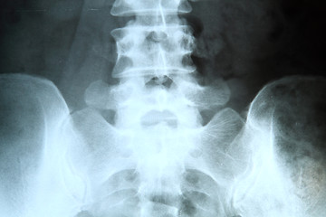 Image showing X-ray of the pelvis and spinal column. 