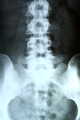 Image showing X-ray of the pelvis and spinal column. 