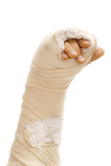 Image showing Broken arm