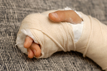 Image showing Broken arm