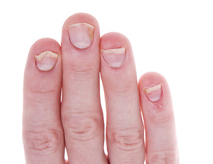 Image showing Psoriasis on Fingernails Isolated White Background