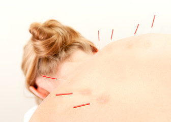 Image showing Acupuncture Patient Treatment in Back