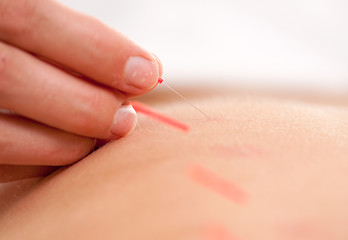 Image showing Acupuncture Stimulation Macro