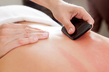 Image showing Gua-Sha Acupuncture Treatment on Back