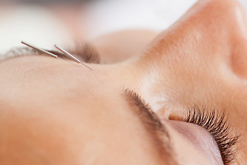 Image showing Facial Acupuncture