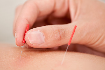 Image showing Acupuncture Macro