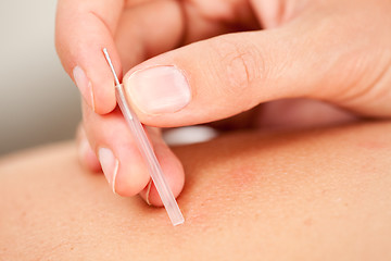 Image showing Acupuncture Needle with Insertion Tube