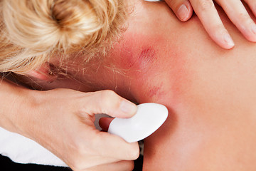 Image showing Redness on Neck after Gua Sha Acupuncture