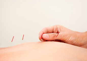 Image showing Acupuncture