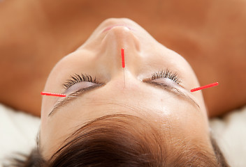 Image showing Anti-Aging Acupuncture Treatment