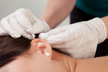 Image showing Auricular Acupuncture Treatment