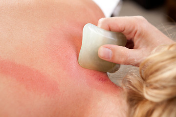 Image showing Redness During Gua Sha