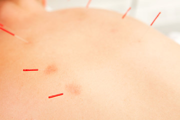 Image showing Back Acupuncture