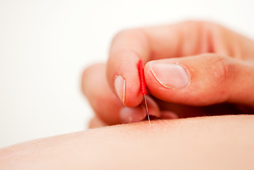 Image showing Acupuncture Needle Being Stimulated