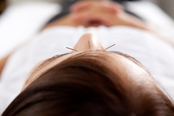 Image showing Acupuncture Facial Treatment Detail