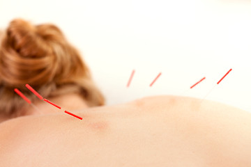 Image showing Acupuncture on Back Shu Points