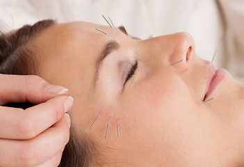 Image showing Facial Acupuncture Treatment Detail