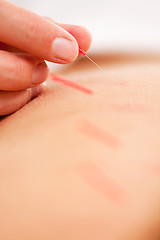 Image showing Qi - Acupuncture Neddle Rotation and Stimulation