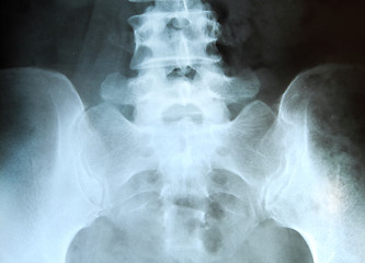 Image showing X-ray of the pelvis and spinal column. 