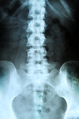 Image showing X-ray of the pelvis and spinal column. 