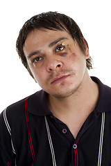 Image showing man with black eye