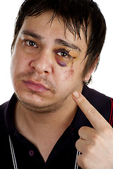 Image showing man pointing at his black eye