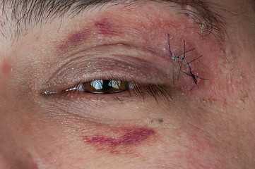Image showing close-up of a stitched wound