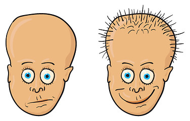 Image showing Illustration - patient with a bald head and hair