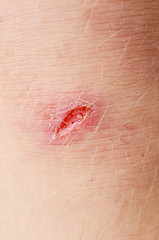 Image showing scar