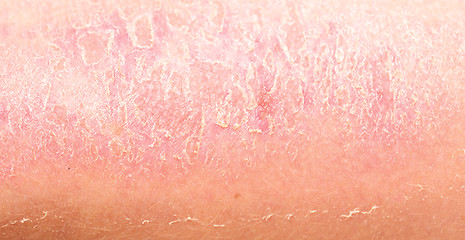 Image showing sunburn