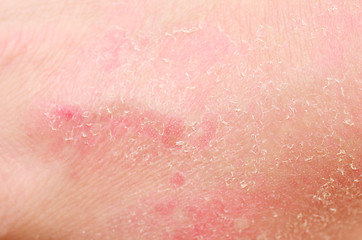 Image showing sunburn