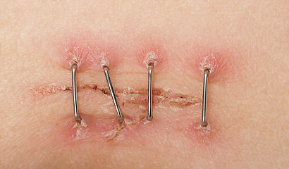 Image showing Surgery Incisions