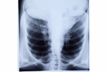 Image showing Woman Chest X-ray