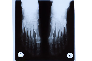 Image showing X-ray of Mature Woman Feet