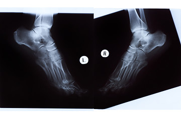 Image showing X-ray of Mature Woman Feet