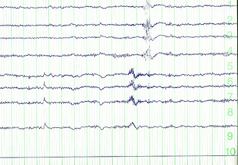 Image showing electro-encephalogramme