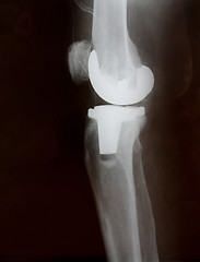 Image showing Total knee replacement x-ray side picture