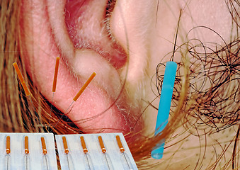 Image showing ear acupuncture