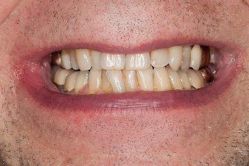 Image showing Macro image of filled teeth