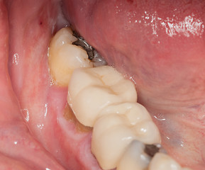 Image showing Macro image of filled teeth