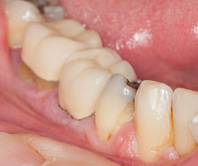 Image showing Macro image of filled teeth