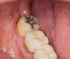 Image showing Macro image of filled teeth