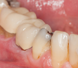 Image showing Macro image of filled teeth