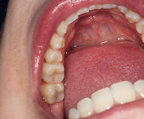 Image showing Macro image of filled teeth