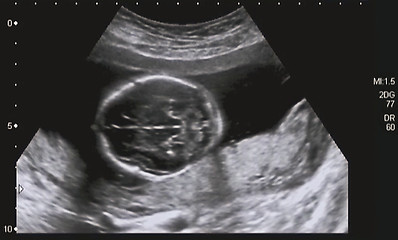 Image showing Ultrasonography Analysis of a 4th Month Fetus