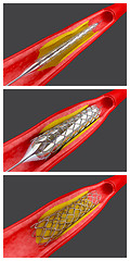 Image showing Angioplasty