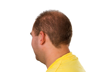 Image showing Young man with hair problem