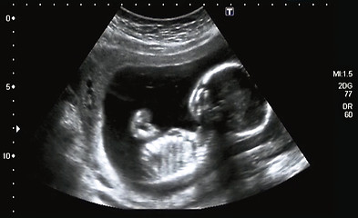 Image showing Ultrasonography Analysis of a 4th Month Fetus