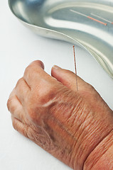 Image showing acupuncture 