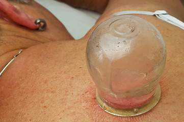 Image showing cupping